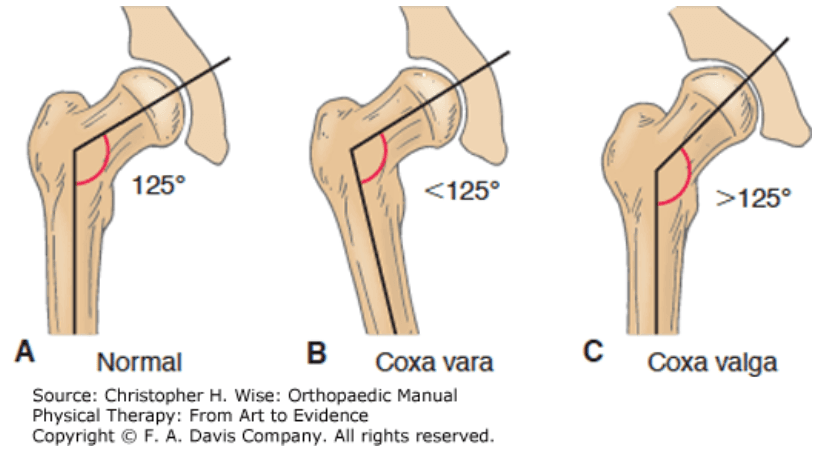 not everyone can do the splits - coxa vara hip structure deformity